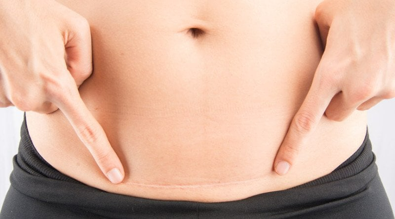 Chửa ở vết mổ có nguy hiểm đến sức khỏe không?1