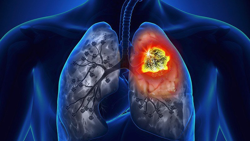 chua-ung-thu-phoi-theo-phac-do-trung-dich-la-nhu-the-nao 1