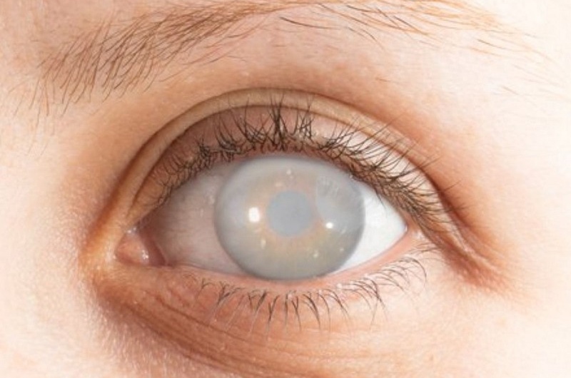 Chứng mù bẩm sinh Leber: Triệu chứng, nguyên nhân, biện pháp chẩn đoán và điều trị 1