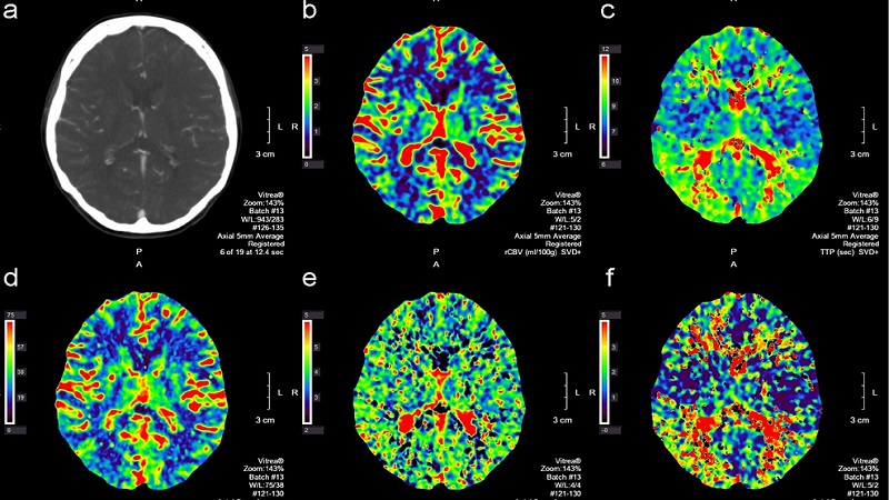 Chụp cắt lớp vi tính tưới máu não và một số thông tin hữu ích 1