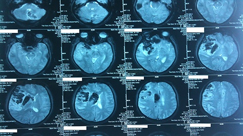 Chụp cộng hưởng từ não là gì? Khi nào cần chụp chụp cộng hưởng từ não? 2