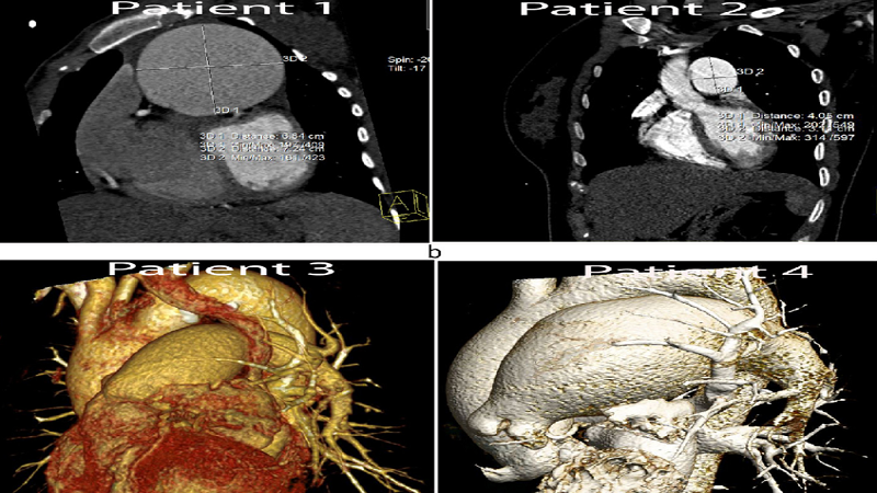 Chụp CT 128 dãy: Ứng dụng, ưu nhược điểm và một số lưu ý 4