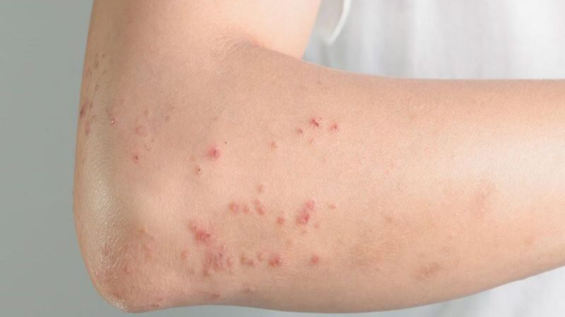 Chụp MRI vú là gì? Khi nào cần thực hiện? 3