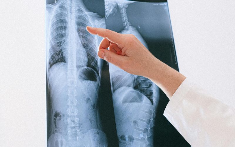 Chụp X-quang có phát hiện khối u không còn tùy thuộc vào kích thước, cấu trúc cũng như tỷ trọng khối u