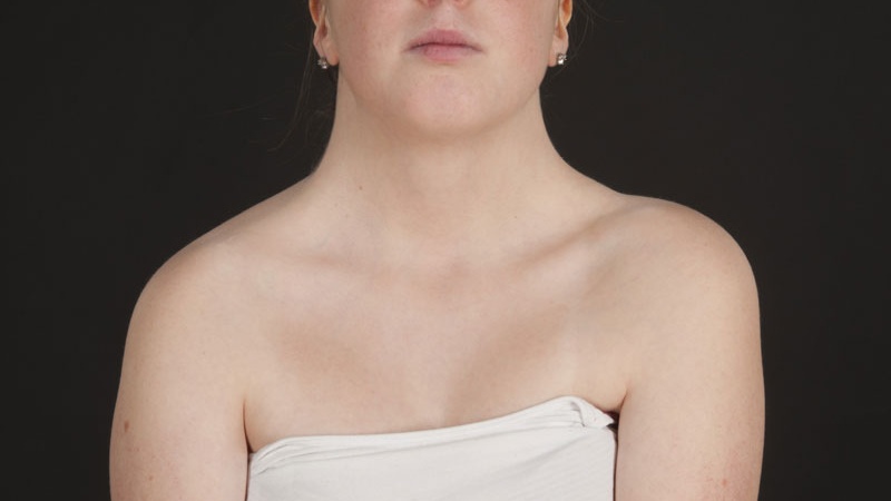 Giải thích cơ chế phát sinh bệnh Turner 1