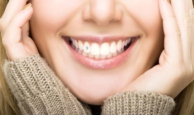 co-nen-dinh-da-rang-tham-my-hay-khong 1.jpg