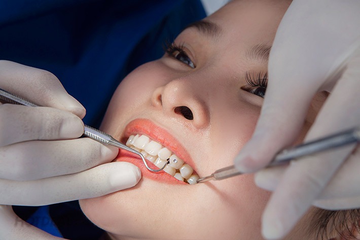 co-nen-dinh-da-rang-tham-my-hay-khong 2.jpg