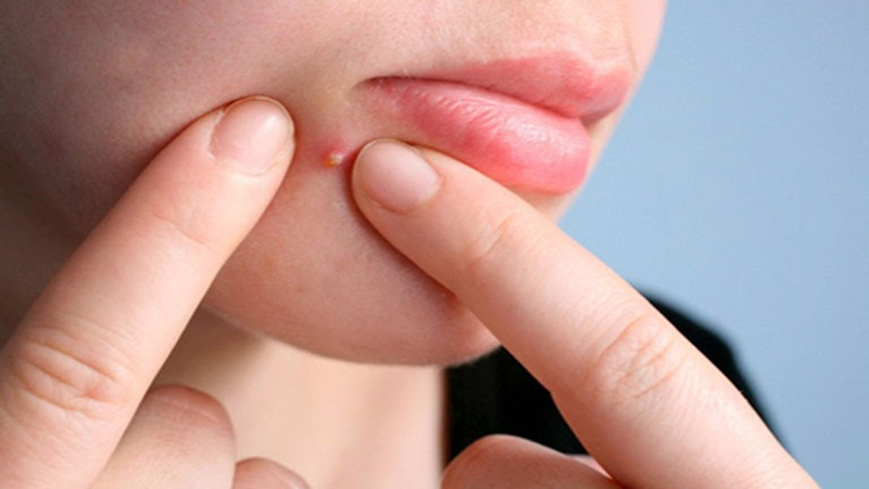 Có nên nặn mụn mủ hay không? Bật mí câu trả lời chính xác nhất 1