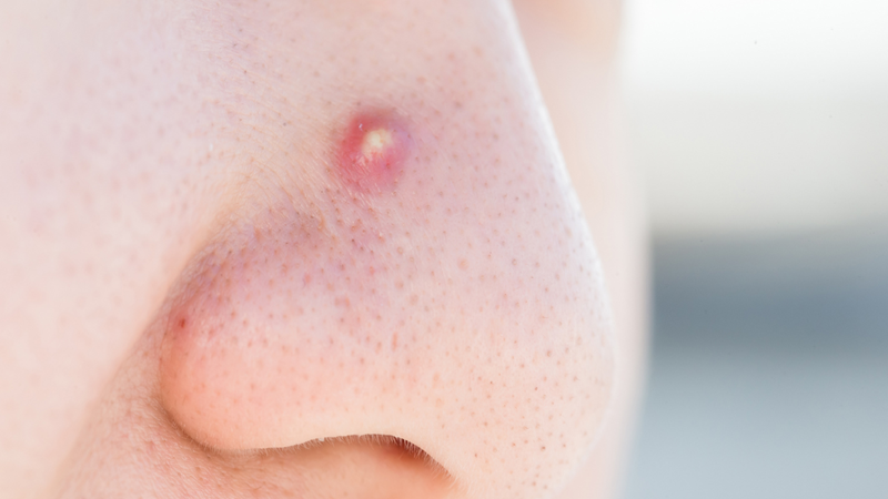 Có nên nặn mụn mủ hay không? Bật mí câu trả lời chính xác nhất 2