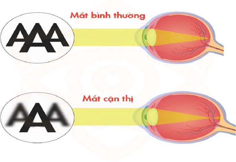 Có nên nhìn mặt trời chữa cận thị không? 3