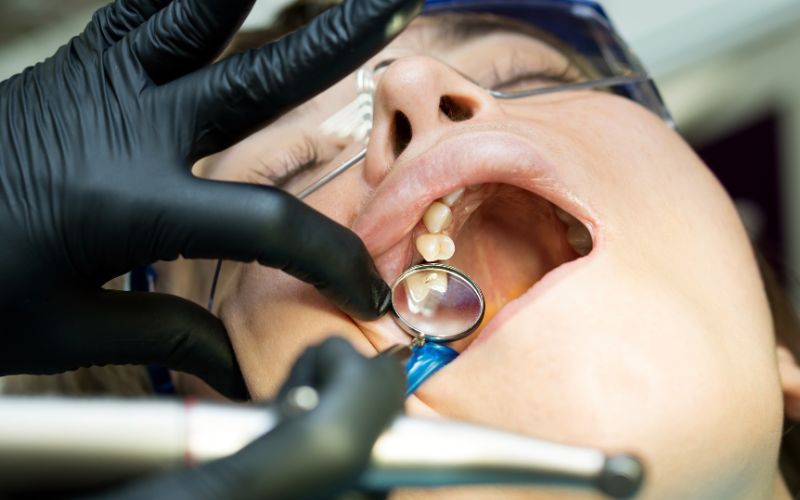 Có nên nhổ răng hàm trên trong cùng bị sâu? 3