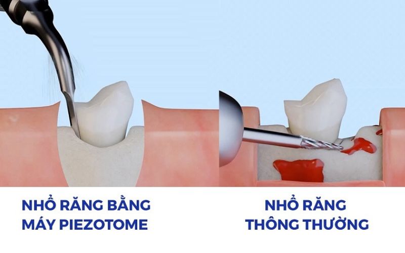 Có nên nhổ răng hàm trên trong cùng bị sâu? 4