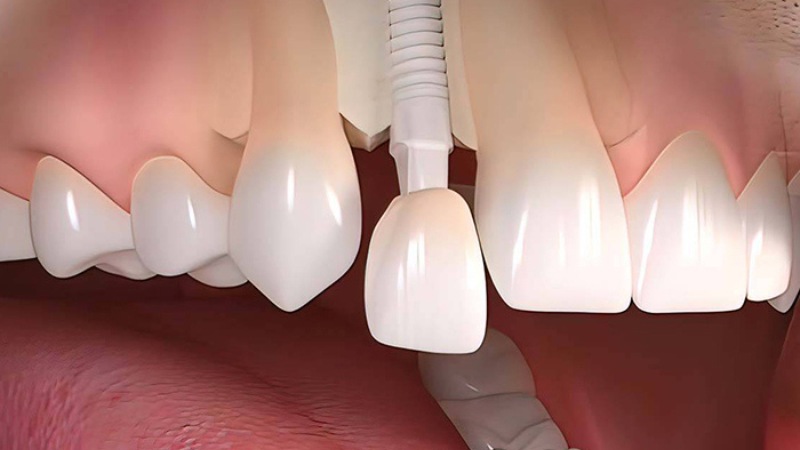 Có nên trồng implant răng cửa không và giá bao nhiêu? 1