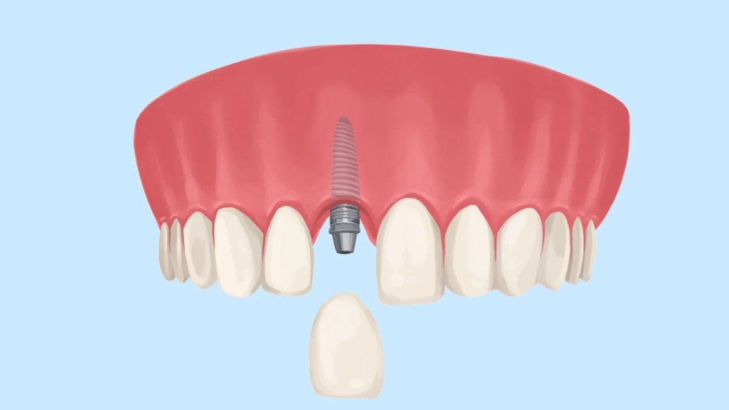 bị gãy răng cửa