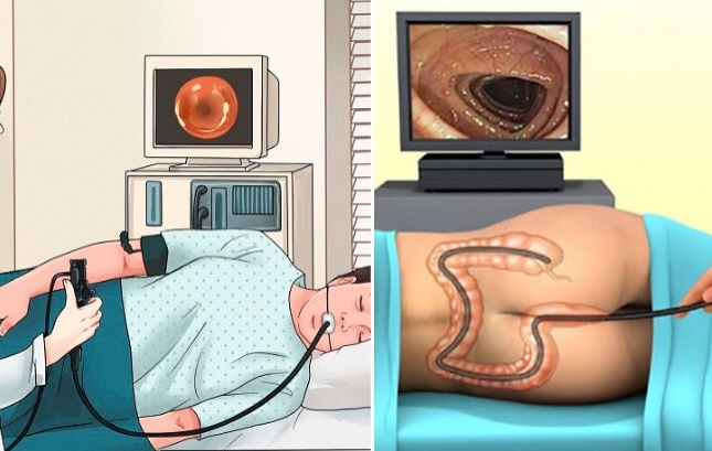 Có những phương pháp nội soi đường ruột phổ biến nào? 2
