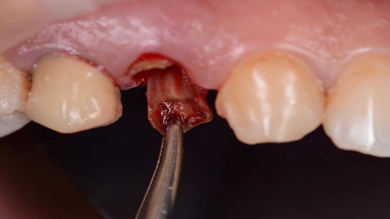 Còn chân răng có nên nhổ không? Nguyên nhân và cách khắc phục 1