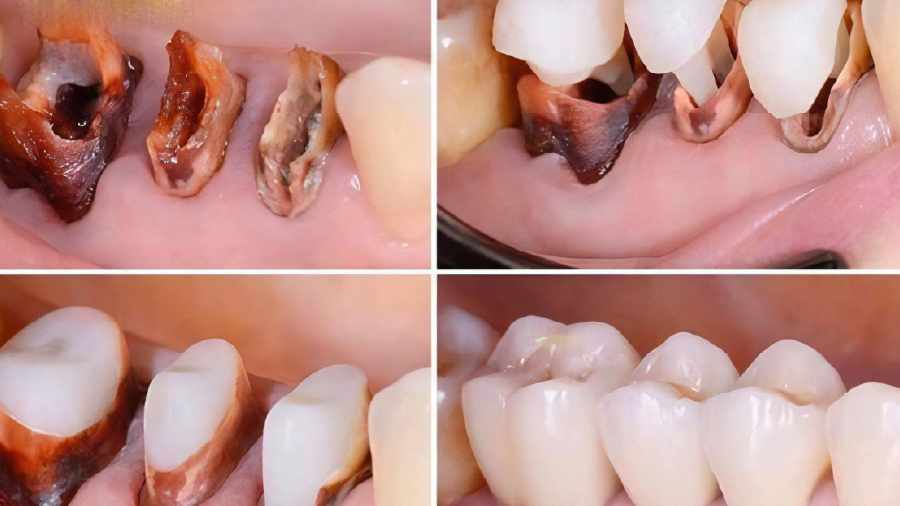 Cui Rangw Cùi răng là gì? Ưu và nhược điểm khi làm cùi răng giả