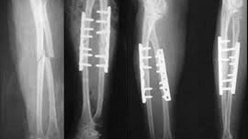 Tìm hiểu: Phẫu thuật mổ rút đinh bao lâu thì đi được? 1