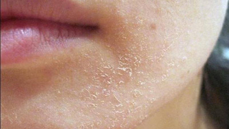 Da bị khô từng mảng: Nguyên nhân và giải pháp 1