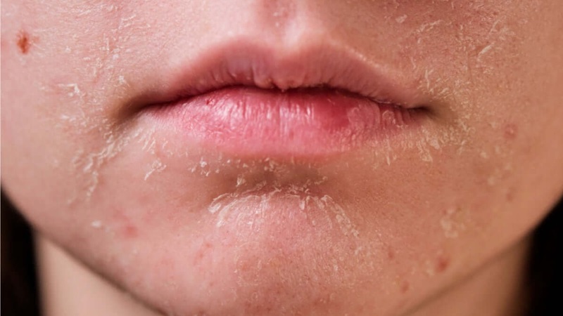 Da khô nghiêm trọng: Dấu hiệu, nguyên nhân và giải pháp 3