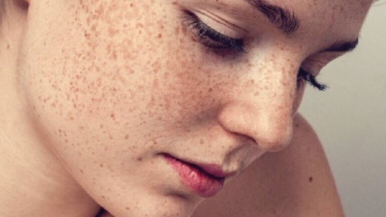 Da nhiễm chì là gì? Da bị nhiễm chì có nguy hiểm không? 2