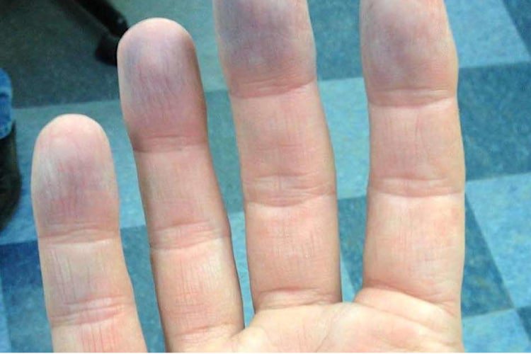 Da xanh tím bị bệnh gì? Nguyên nhân và cách điều trị 1