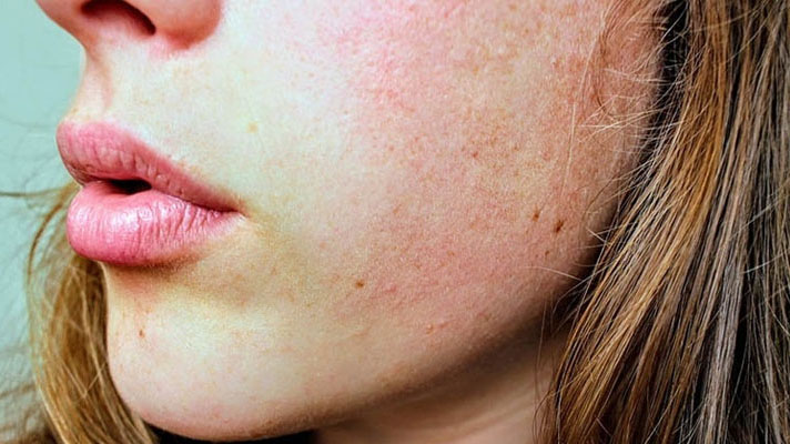 Đắp mặt nạ thấy rát: Nguyên nhân và cách khắc phục hiệu quả 1