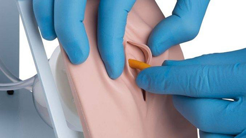 Đặt ống thông tiểu khi mổ đẻ tại sao lại cần thiết?