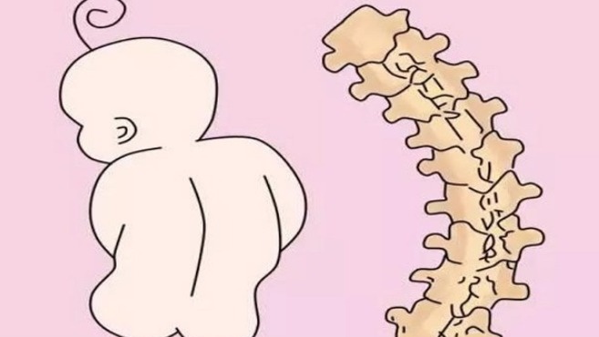 Dấu hiệu bé bị gù lưng bẩm sinh 1