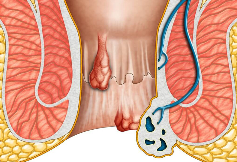 dấu hiệu bệnh trĩ ngoại và nguyên nhân gây bệnh trĩ ngoại 2