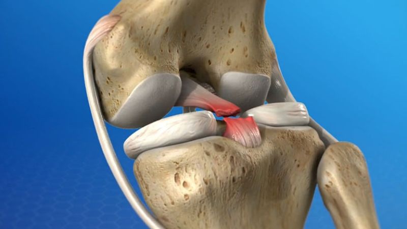 Dấu hiệu đứt dây chằng khớp gối và cách điều trị 1