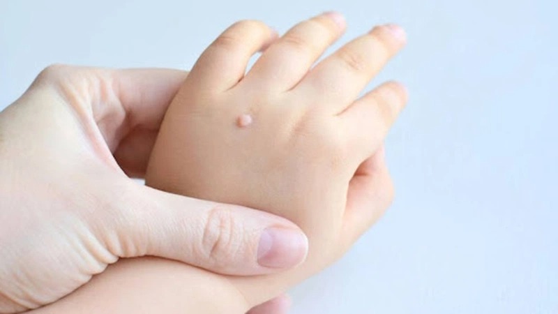 Dấu hiệu nhận biết sùi mào gà ở tay 3