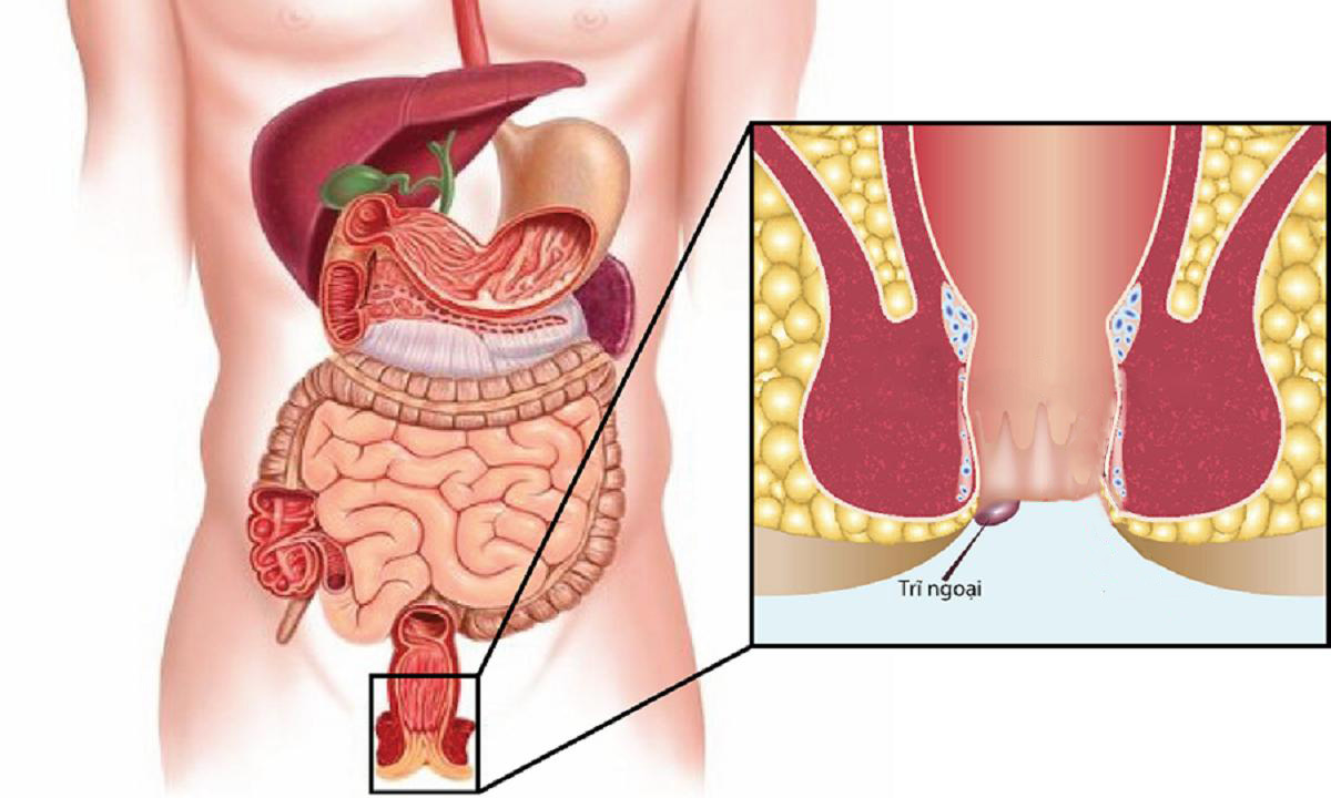 Phân biệt bệnh trĩ ngoại nhẹ và cách điều trị đơn giản - Nhà ...