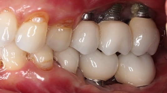 dau-hieu-tru-implant-bi-dao-thai-va-cach-khac-phuc-tinh-trang-nay 2