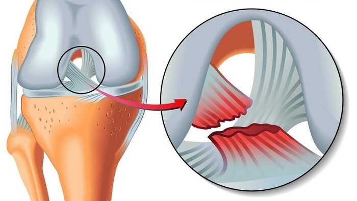 Dấu hiệu và phương pháp điều trị chấn thương ACL