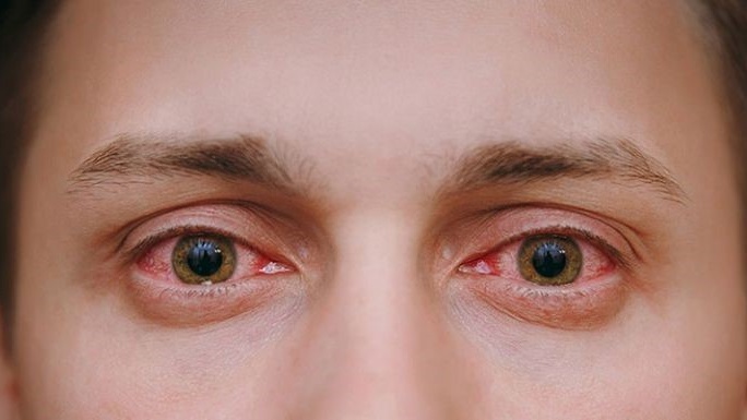 Đau mắt đỏ có ăn được tôm không? Những thực phẩm cần kiêng kị 2