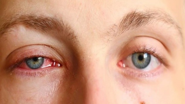 dau-mat-do-deo-kinh-gi-de-giup-cai-thien-tinh-trang-benh 1