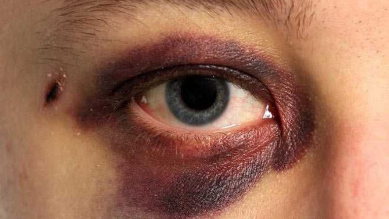 Đau mắt đỏ sưng phù nề: Nguyên nhân, cách điều trị và phòng ngừa 2