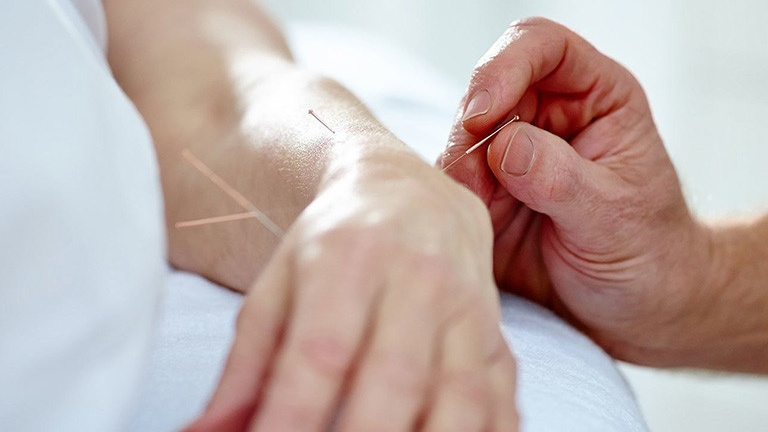 Châm cứu giúp giảm đau nhức lòng bàn tay phải