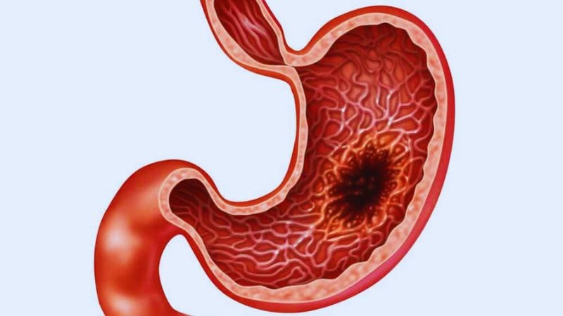 Đau tá tràng: Nguyên nhân và dấu hiệu nhận biết 3