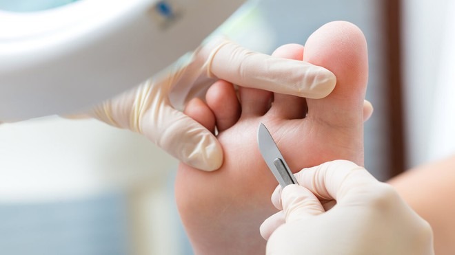 day-sung-long-ban-chan-va-cach-dieu-tri 3.jpg