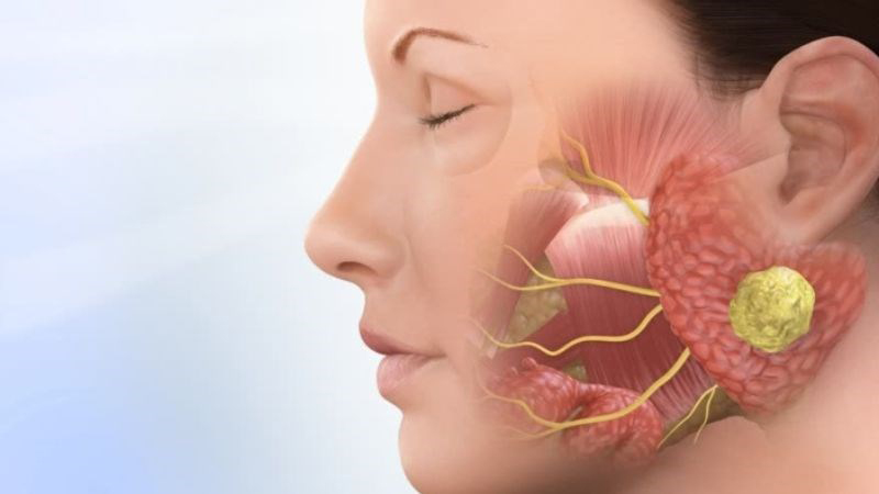 Dây thần kinh số 5 là bệnh gì? Đau dây thần kinh số 5 có nguy hiểm không? 2