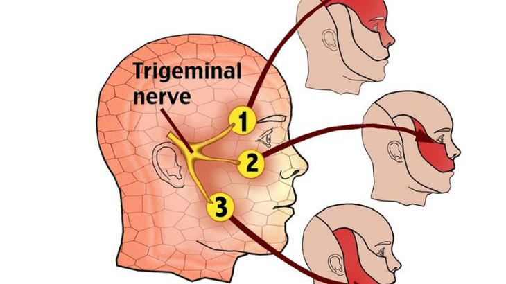 Dây thần kinh số 5 là bệnh gì? Đau dây thần kinh số 5 có nguy hiểm không? 1