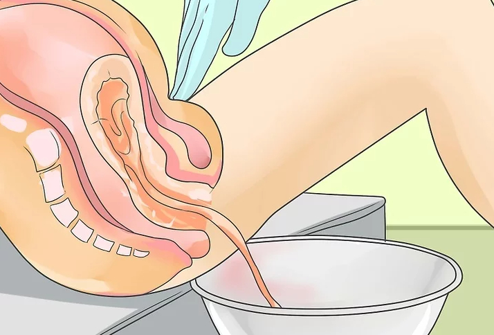 Đẻ rơi là gì? Cách xử trí trong các trường hợp đẻ rơi 3