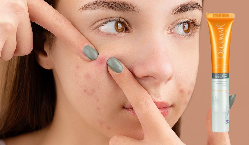 Decumar trị mụn có tốt không? Sử dụng bao lâu có hiệu quả?