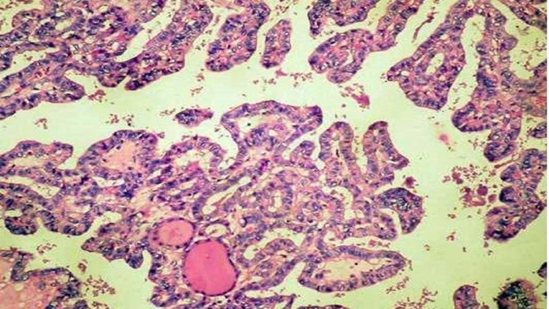 Dị sản ruột dạ dày: Nguyên nhân, dấu hiệu, chẩn đoán và điều trị 1