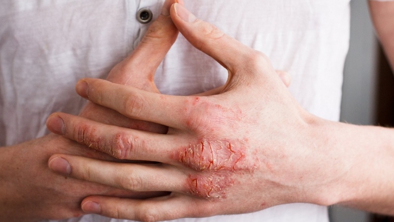 Cách khắc phục dị ứng nước rửa chén 1