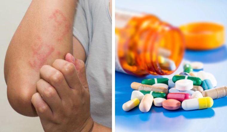 Dị ứng thuốc kháng sinh là gì? Hướng dẫn bạn cách chữa dị ứng thuốc kháng sinh tại nhà 6