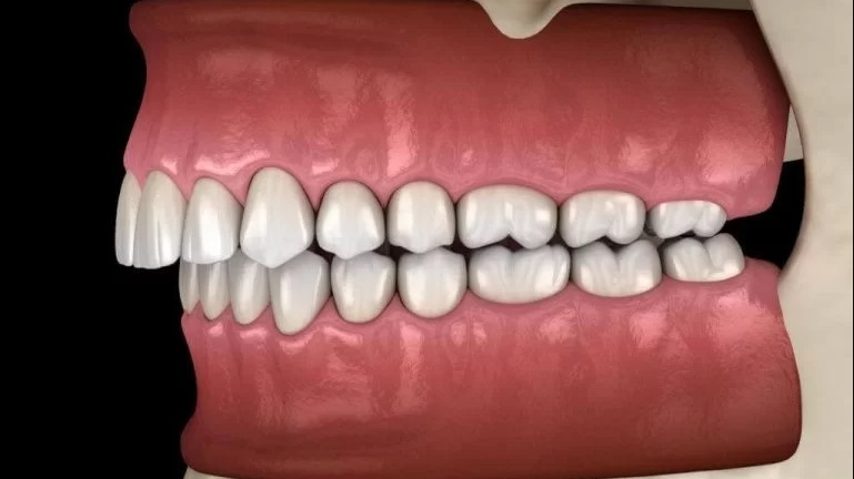 Di xa toàn hàm là gì? Di xa toàn hàm bằng mini vít 3