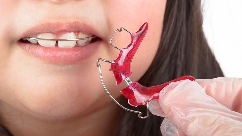 Điều gì xảy ra nếu niềng răng xong không đeo hàm duy trì 2